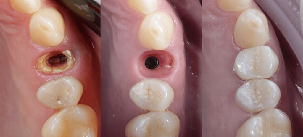 Antes e depois de implante dentário