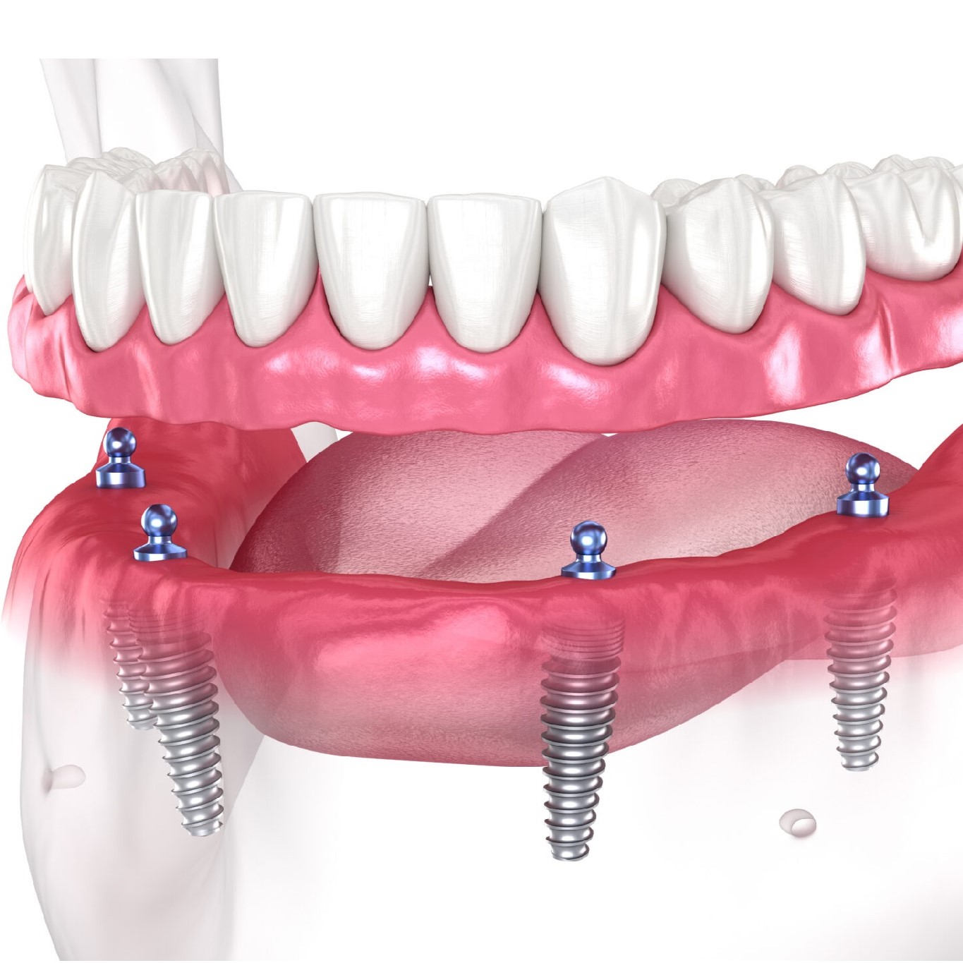 Prótese sobre implantes